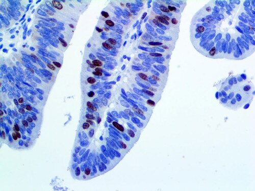 IHC of Survivin on an FFPE Colon Tissue